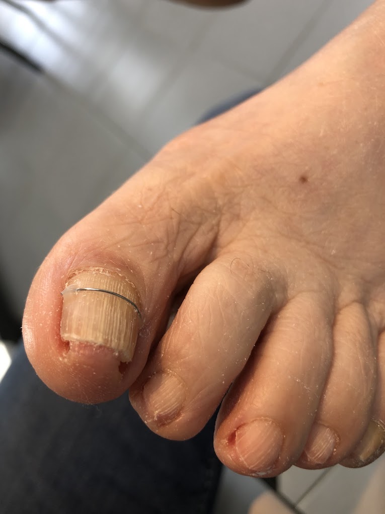 Orthonyxie posée sur l'ongle du gros orteil : fil correcteur métallique fixé transversalement sur un ongle épaissi et incurvé